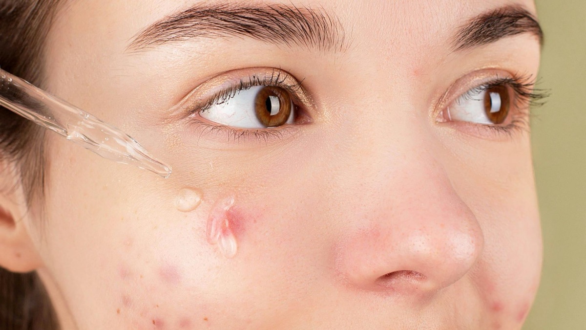 5 Reasons It's Okay To Wear Pimple Patches In Public
