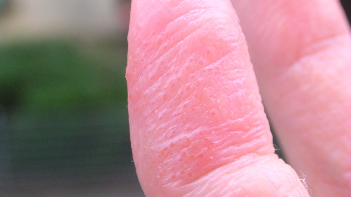 5 Symptoms of Eczema