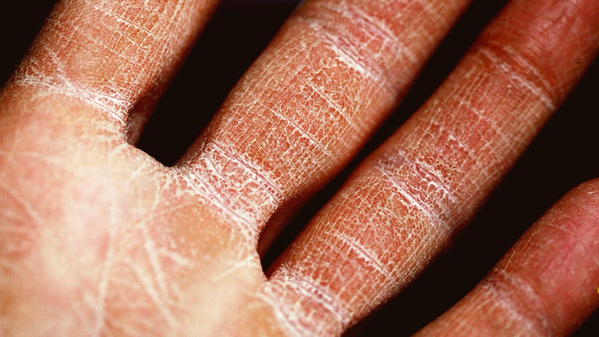 5 Symptoms of Eczema