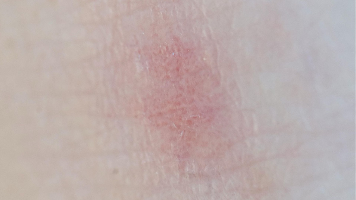 5 Symptoms of Eczema